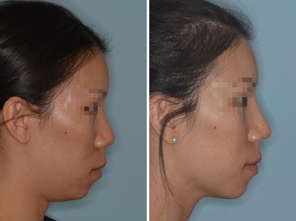 Rhinoplasty before and after, lateral right.