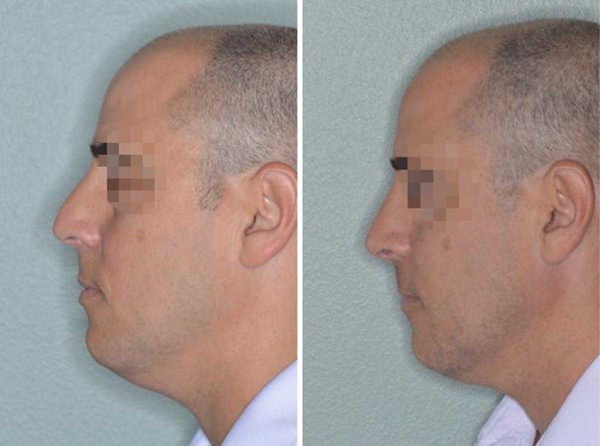 Rhinoplasty before and after, lateral left.