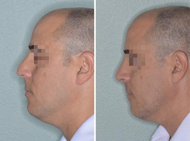 Rhinoplasty before and after, lateral left.