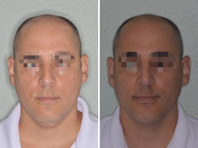 Rhinoplasty before and after, frontal.