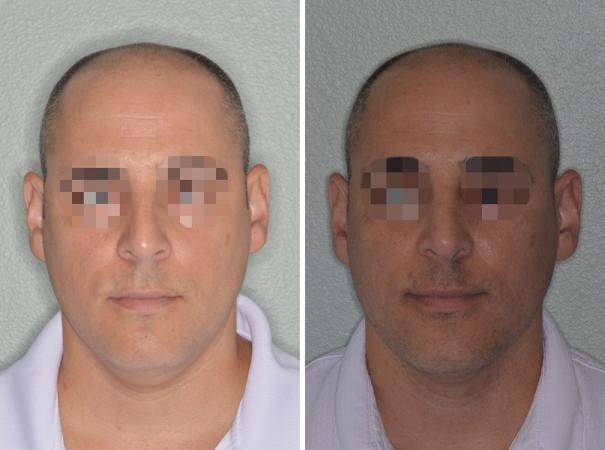 Rhinoplasty before and after, frontal.