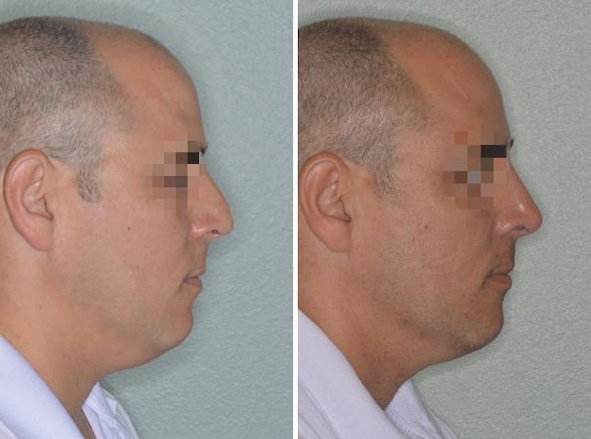 Rhinoplasty before and after, lateral right.