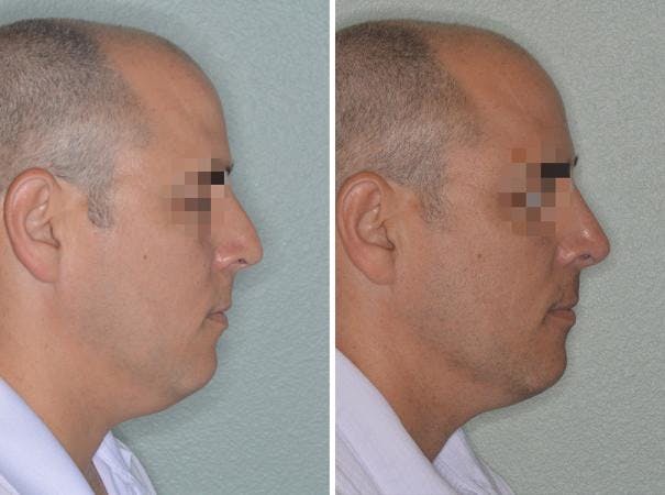 Rhinoplasty before and after, lateral right.