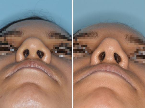 Rhinoplasty before and after, frontal.
