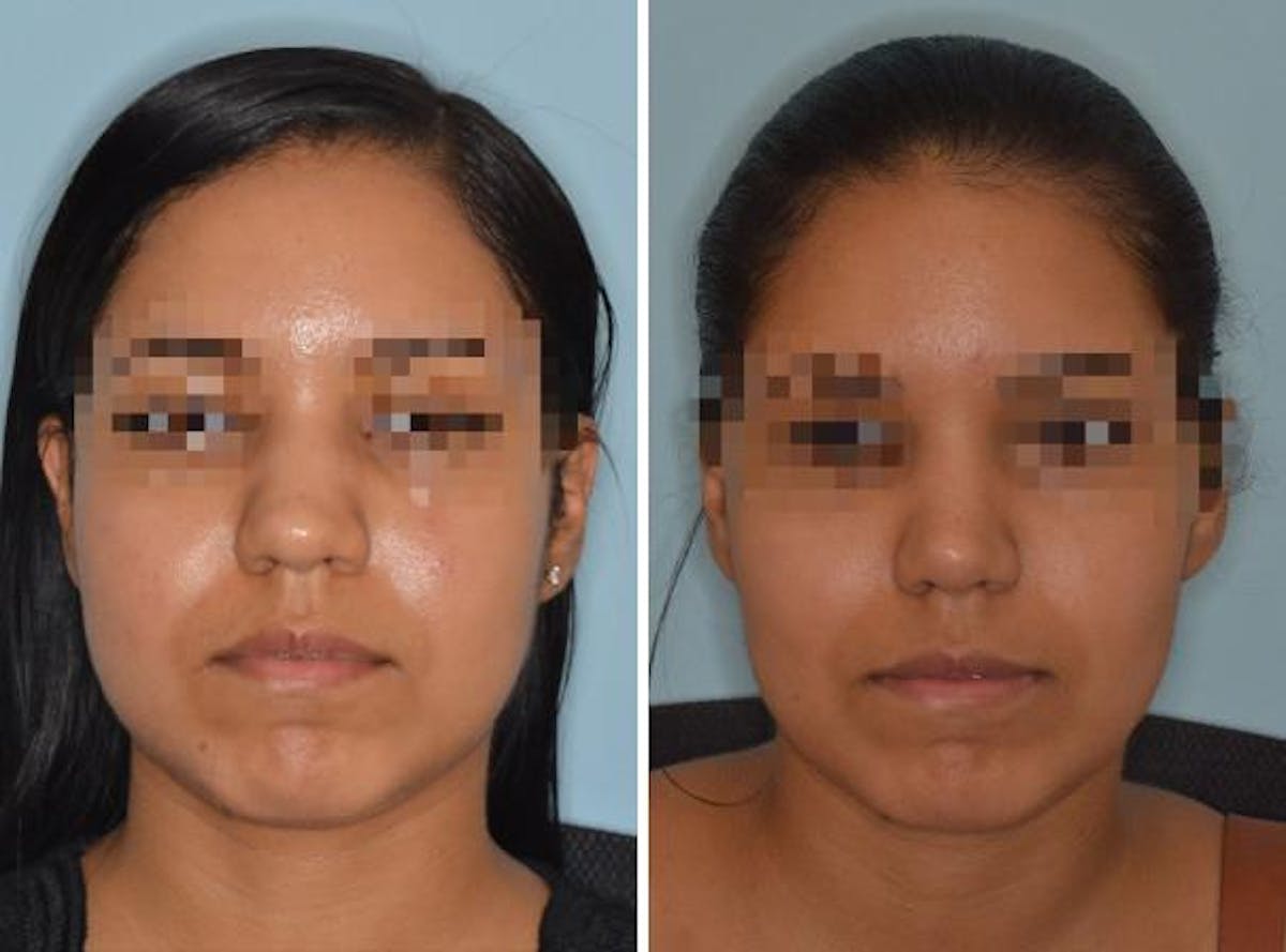Rhinoplasty before and after, frontal.