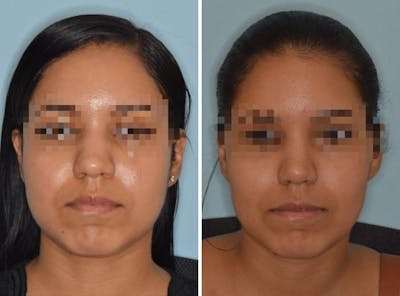 Rhinoplasty before and after, frontal.