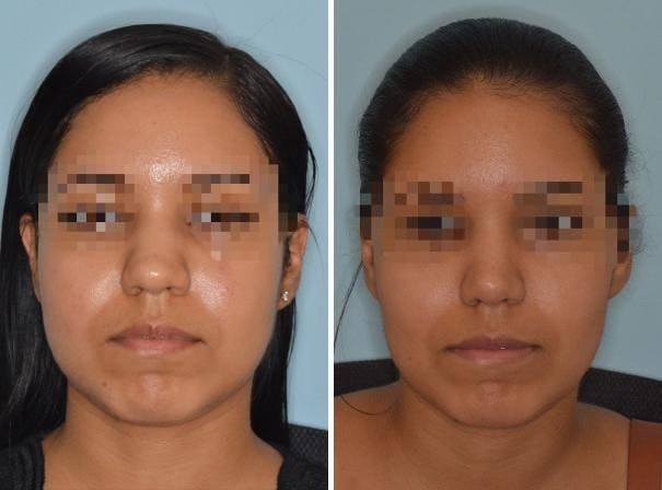 Rhinoplasty before and after, frontal.