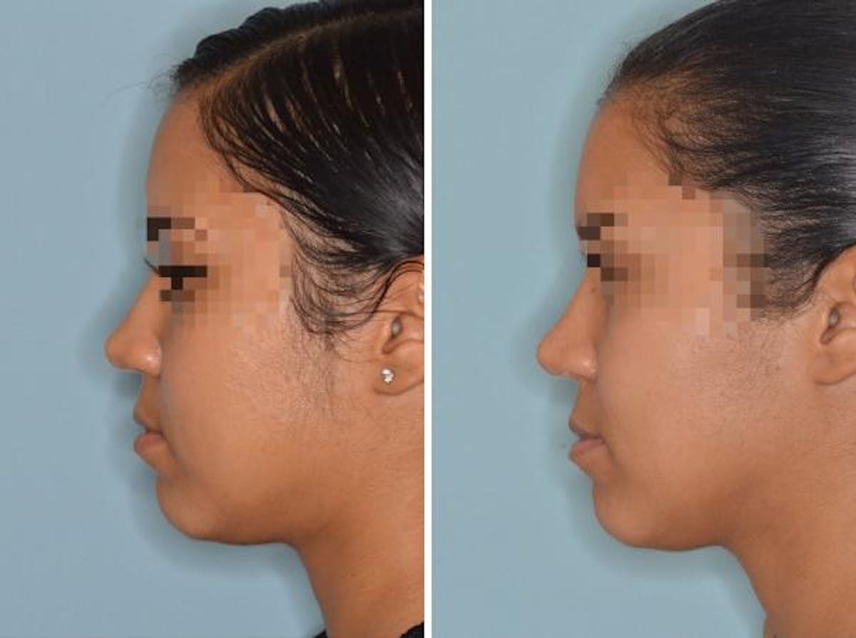 Rhinoplasty before and after, lateral left.