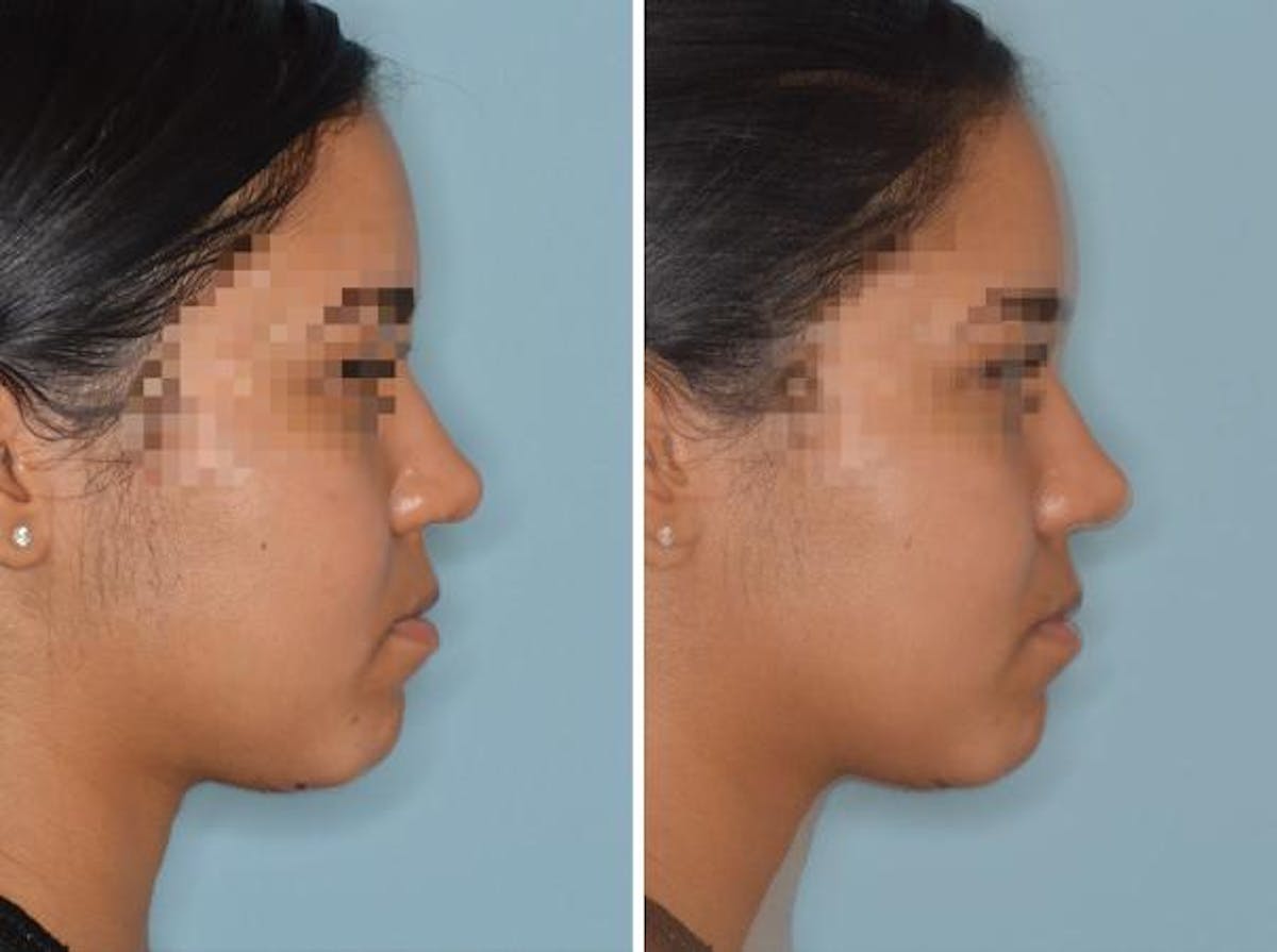 Rhinoplasty before and after, lateral right.