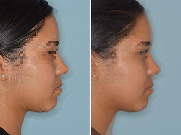 Rhinoplasty before and after, lateral right.