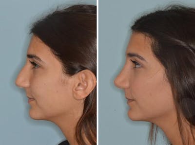 Rhinoplasty before and after, lateral left.