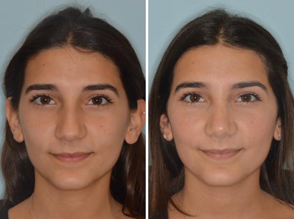 Rhinoplasty before and after, frontal.