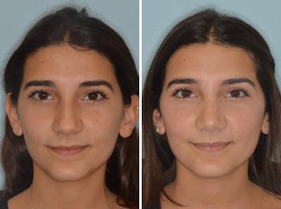 Rhinoplasty before and after, frontal.