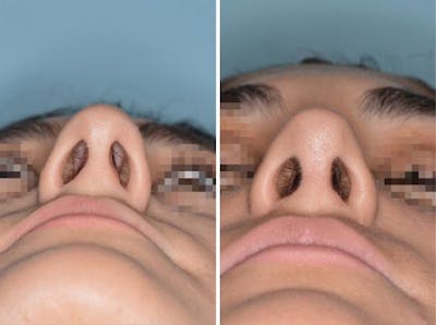 Rhinoplasty before and after, frontal.