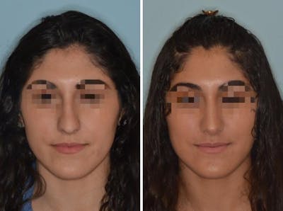 Rhinoplasty before and after, frontal.
