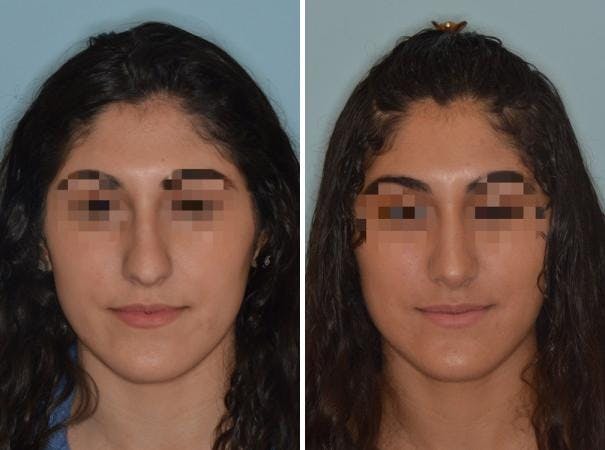 Rhinoplasty before and after, frontal.