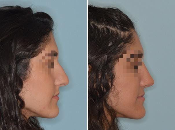 Rhinoplasty before and after, lateral right.