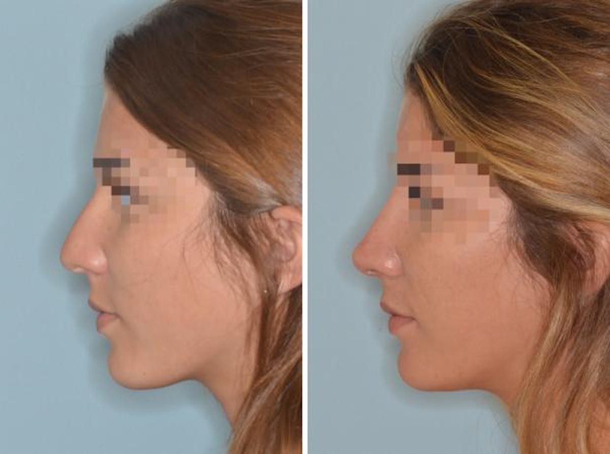 Rhinoplasty before and after, lateral left.