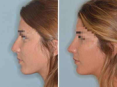 Rhinoplasty before and after, lateral left.