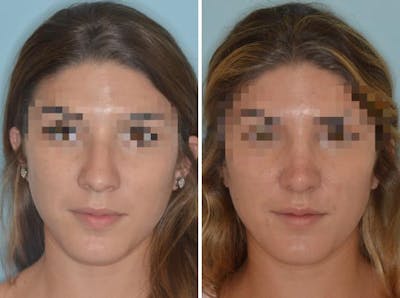 Rhinoplasty before and after, frontal.