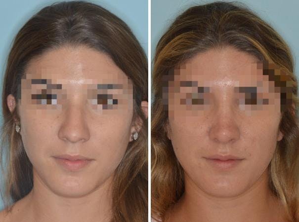 Rhinoplasty before and after, frontal.