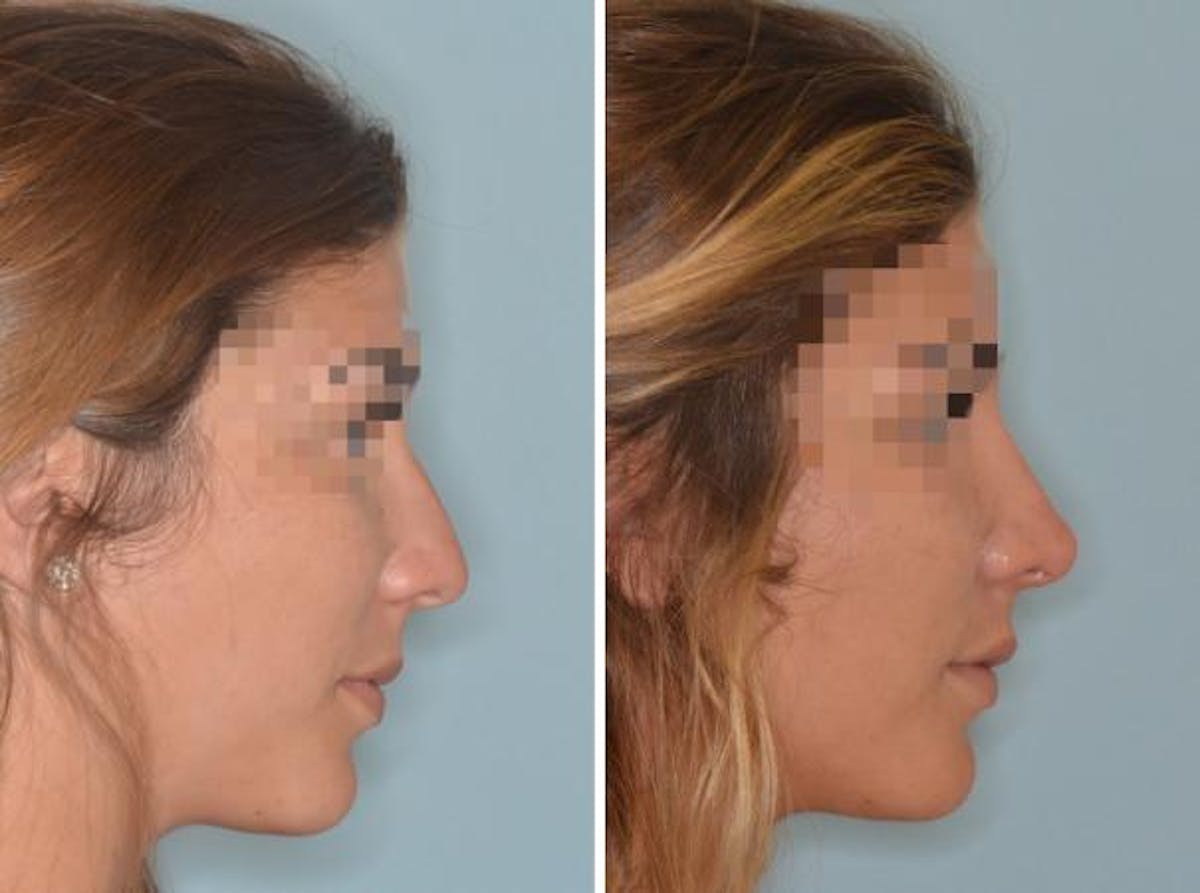 Rhinoplasty before and after, lateral right.