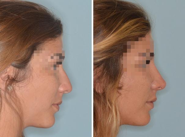 Rhinoplasty before and after, lateral right.