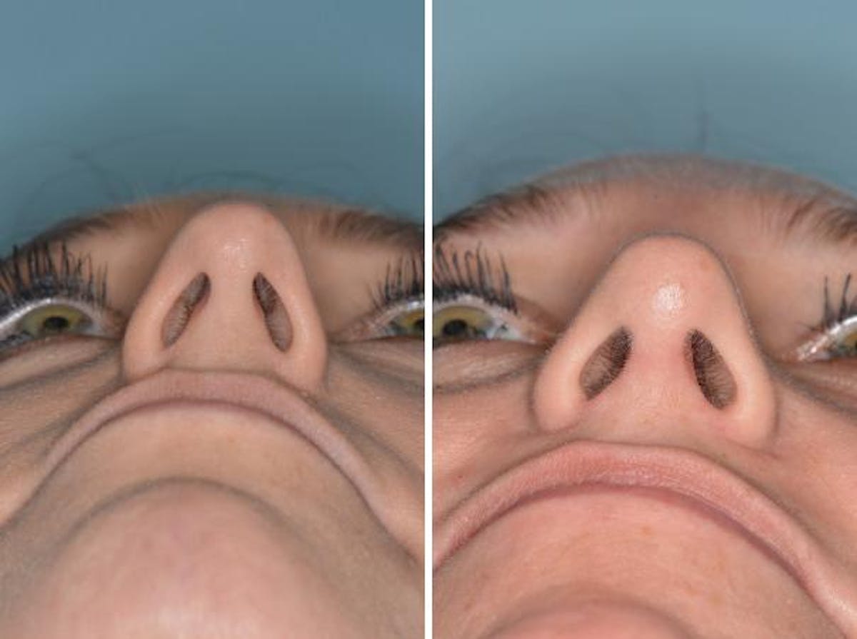 Rhinoplasty before and after, frontal.