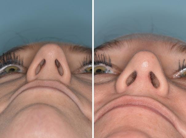 Rhinoplasty before and after, frontal.