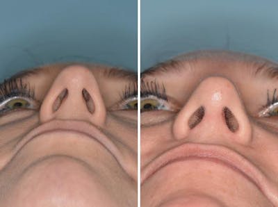 Rhinoplasty before and after, frontal.