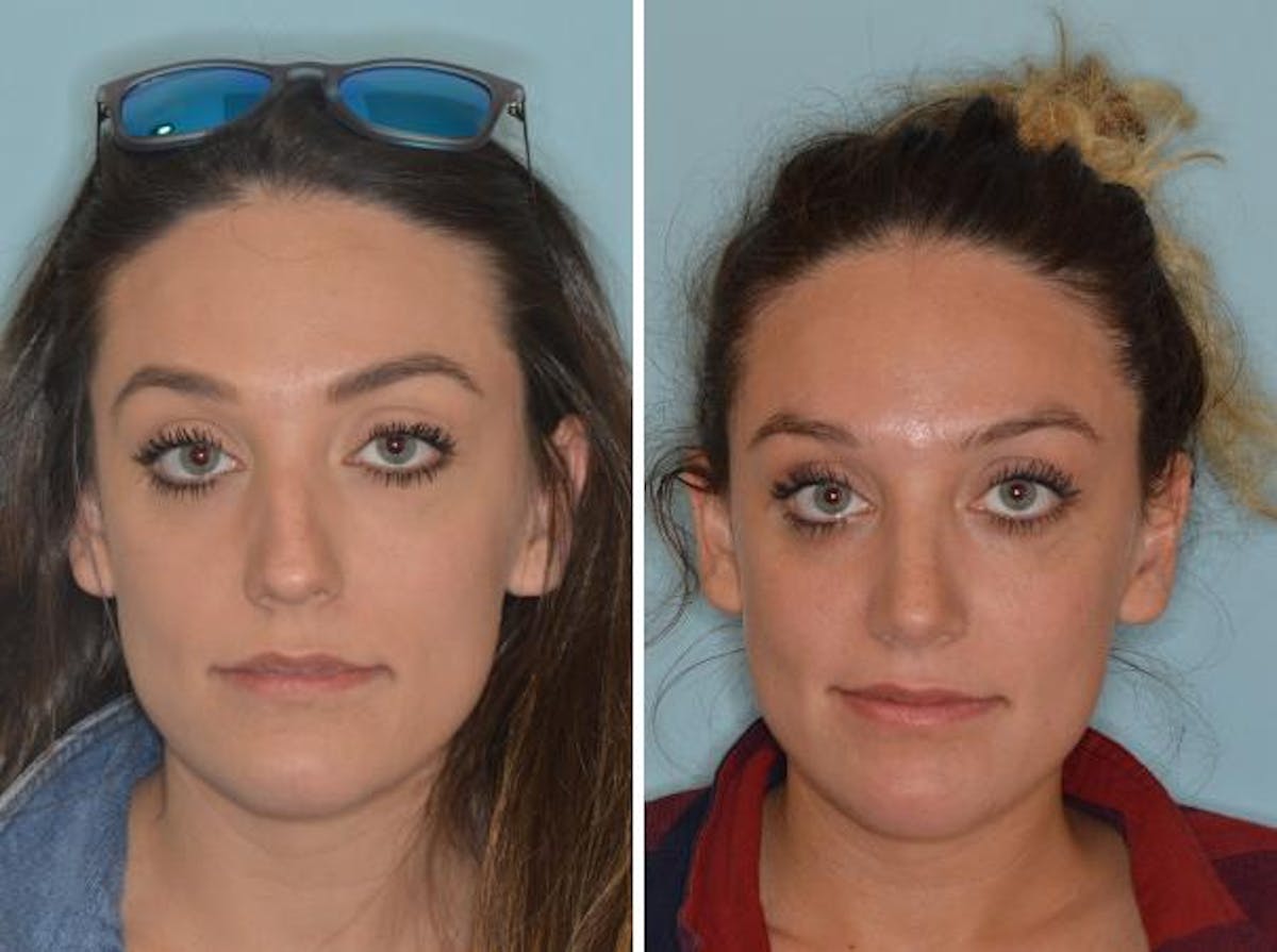 Rhinoplasty before and after, frontal.