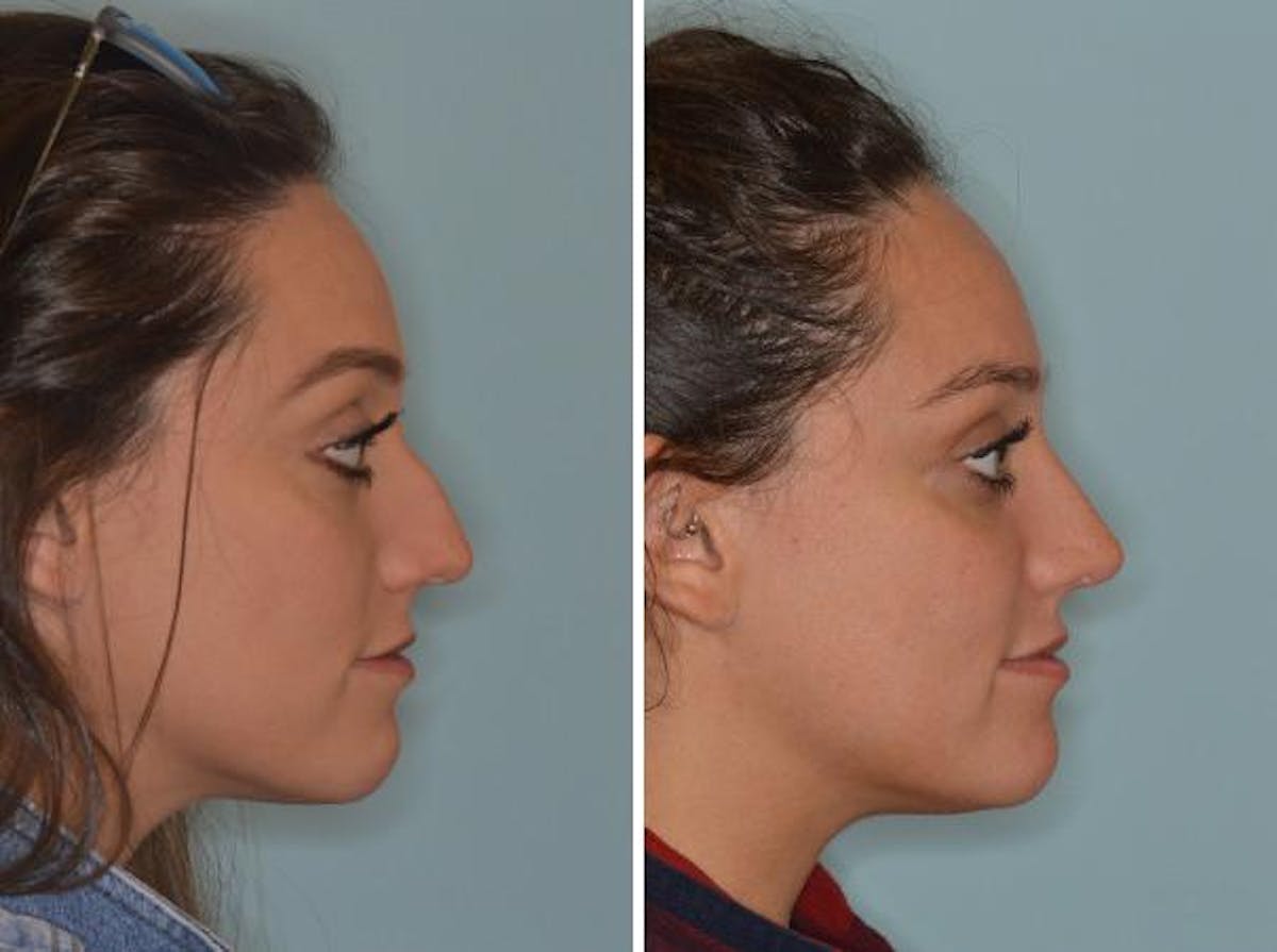 Rhinoplasty before and after, lateral right.