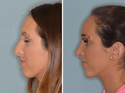 Rhinoplasty before and after, lateral left.