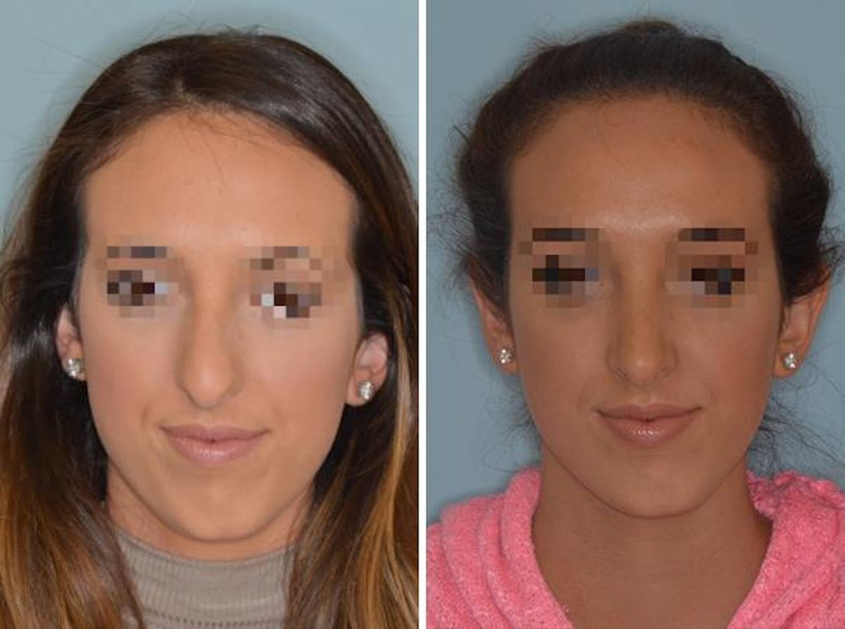 Rhinoplasty before and after, frontal.