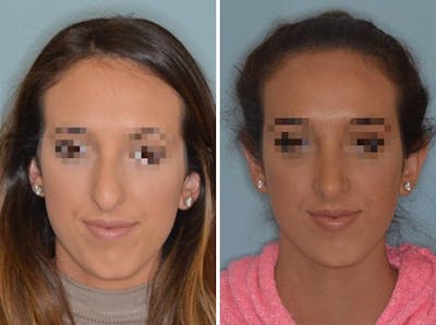 Rhinoplasty before and after, frontal.