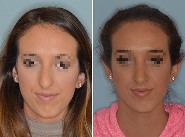 Rhinoplasty before and after, frontal.