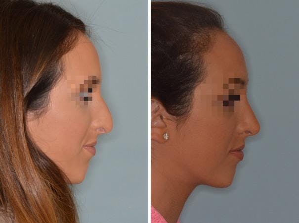 Rhinoplasty before and after, lateral right.