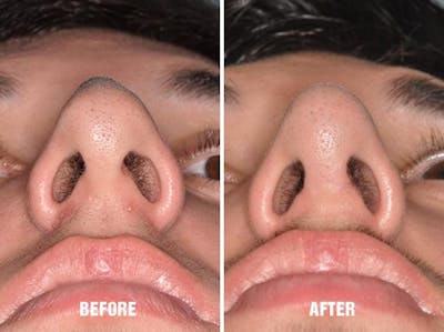 Rhinoplasty before and after, frontal.