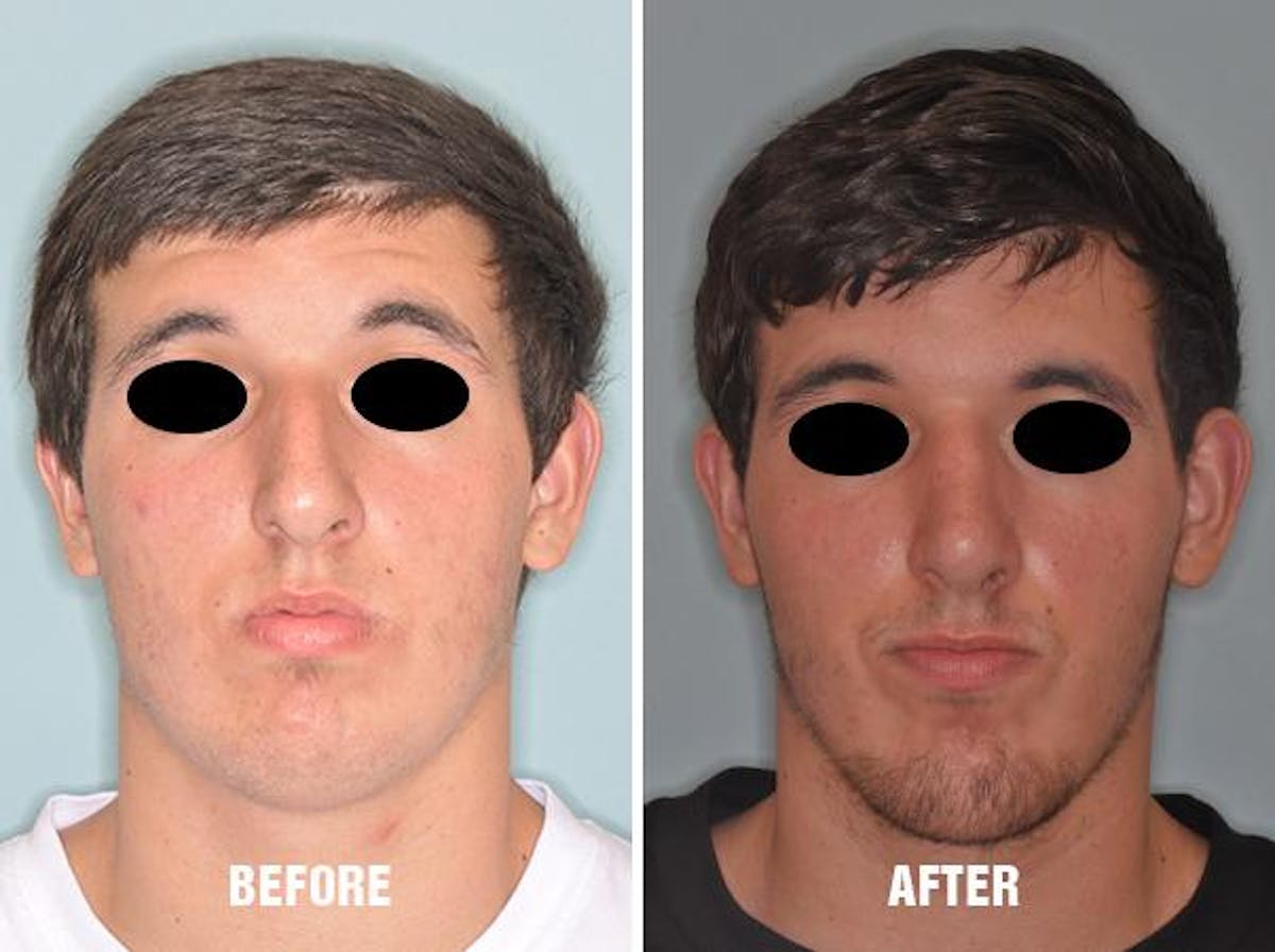 Rhinoplasty before and after, frontal.