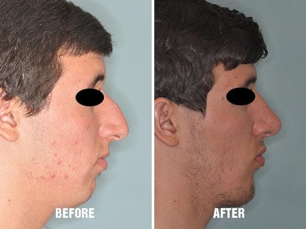 Rhinoplasty before and after, lateral right.