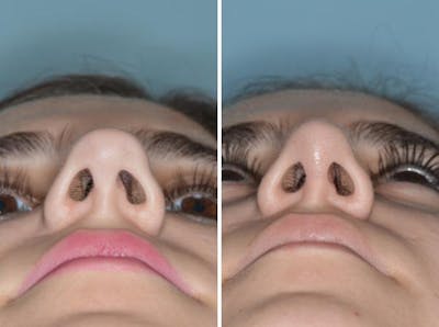 Rhinoplasty before and after, frontal.