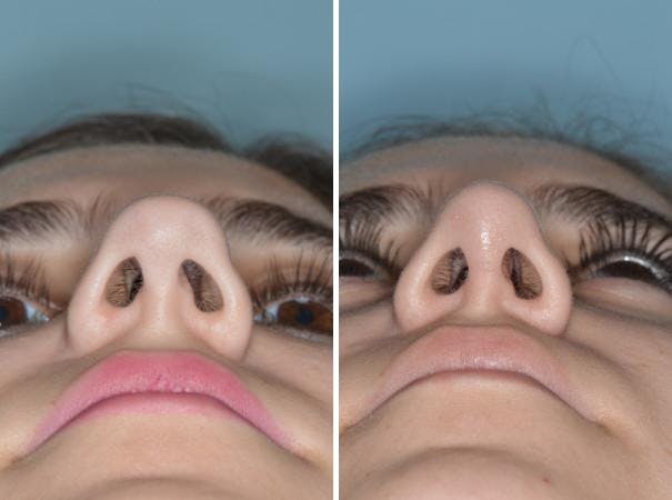 Rhinoplasty before and after, frontal.