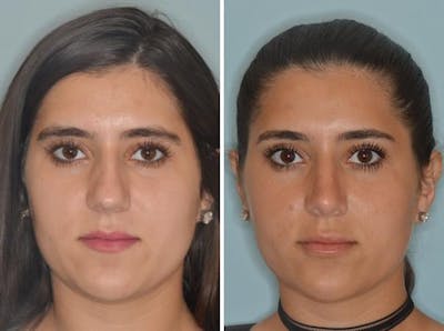 Rhinoplasty before and after, frontal.