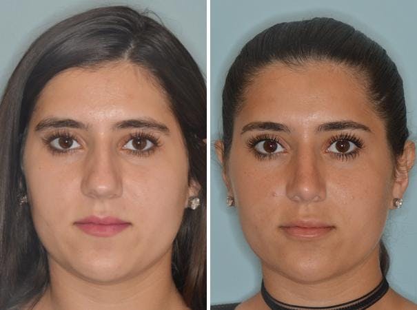 Rhinoplasty before and after, frontal.