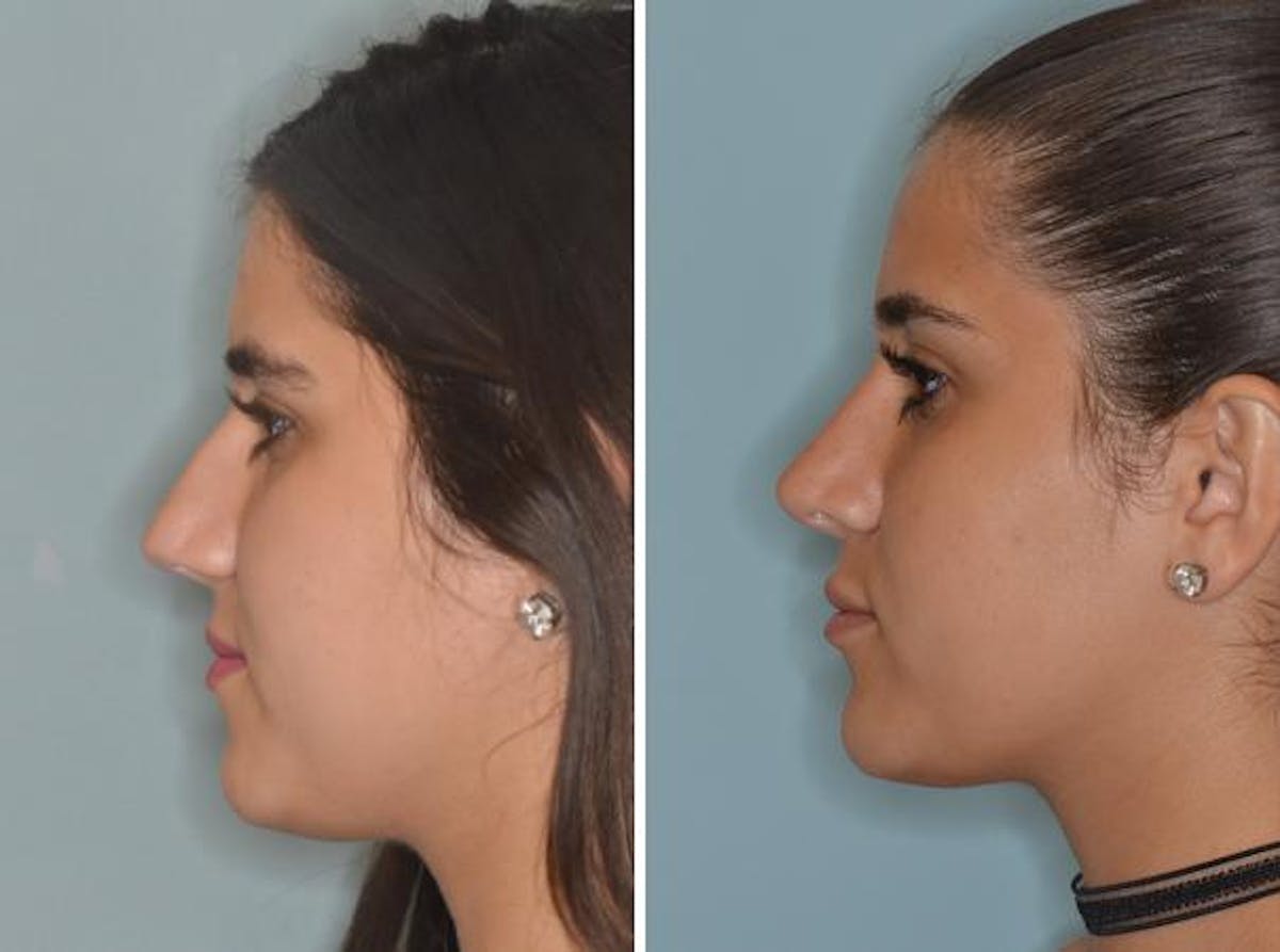 Rhinoplasty before and after, lateral left.