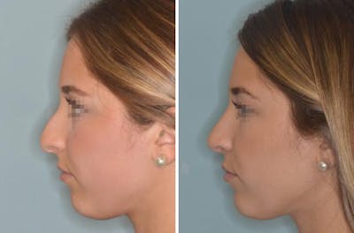 Rhinoplasty before and after, lateral left.