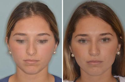 Rhinoplasty before and after, frontal.