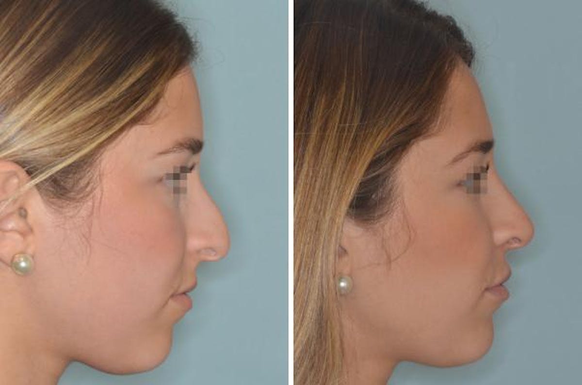 Rhinoplasty before and after, lateral right.