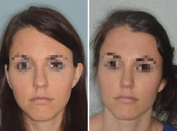 Rhinoplasty before and after, frontal.