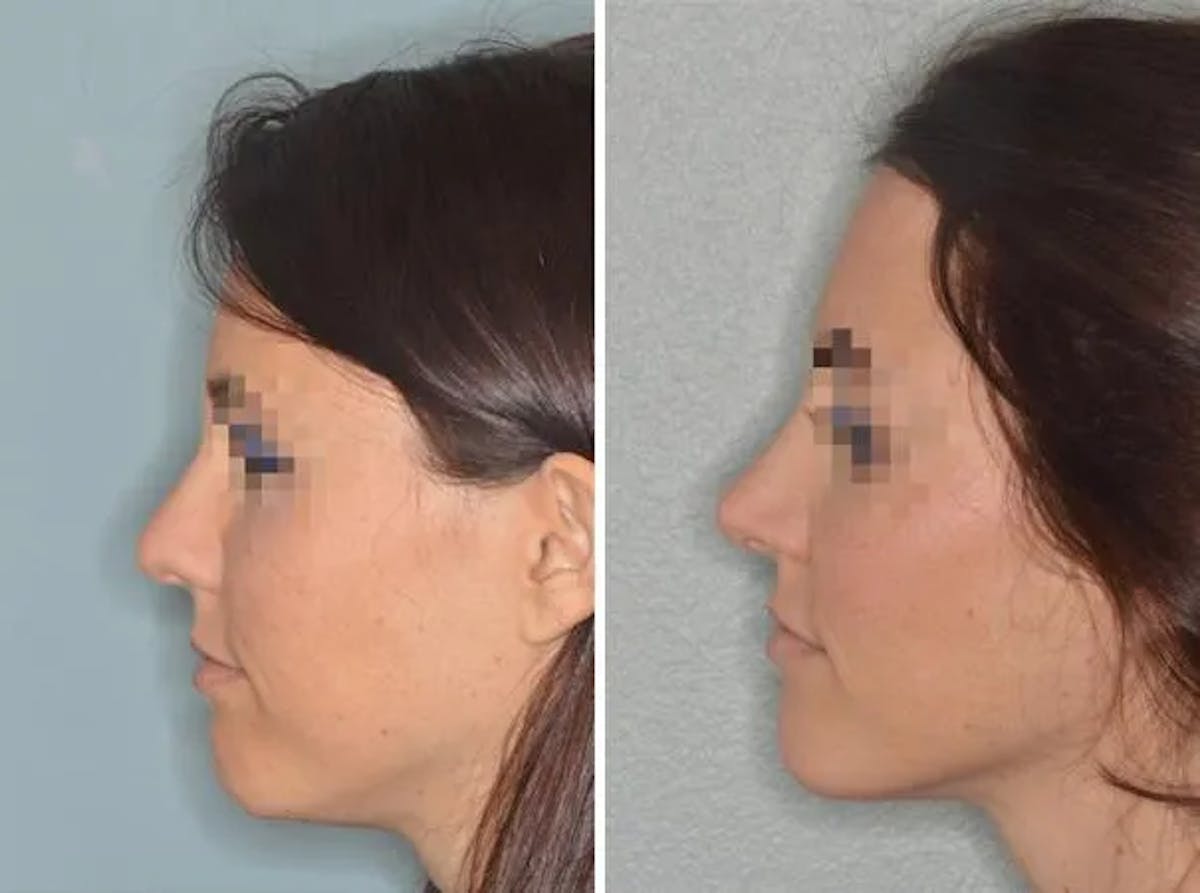 Rhinoplasty before and after, lateral left.
